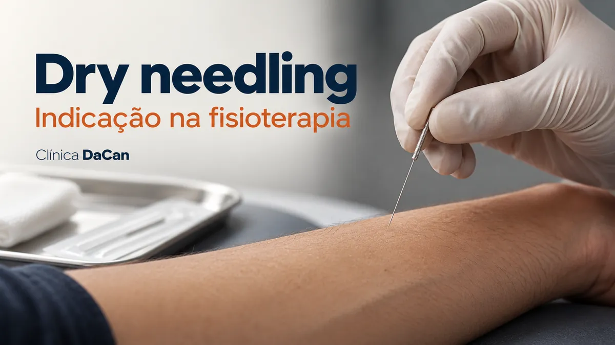 Capa ilustrativa do artigo: Dry needling: o que é, como é feito e quando pode fazer parte da fisioterapia